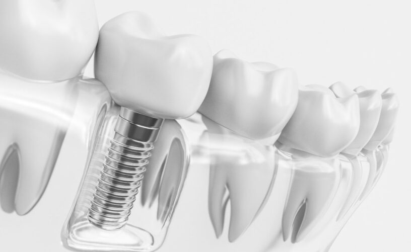 Blog inner thumb : Dorset Dental