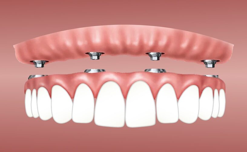 blog - Dorset Dental