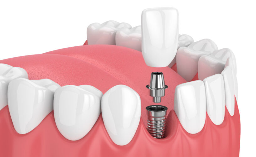 Blog inner thumb : Dorset Dental