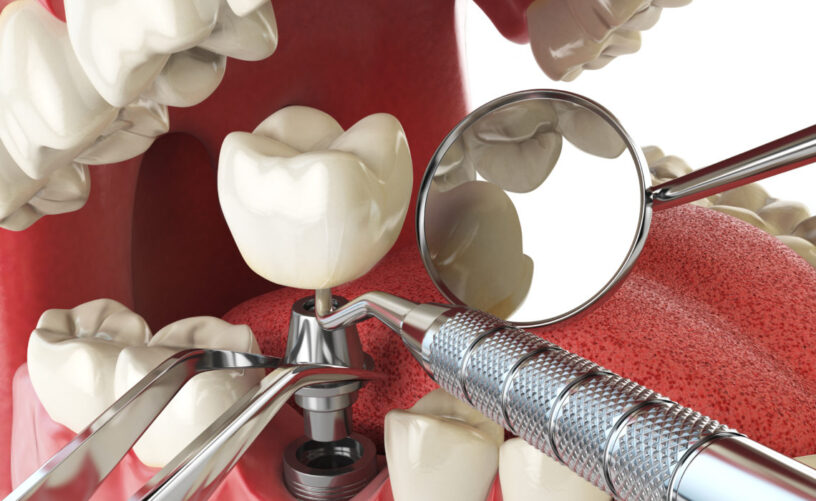 Blog inner thumb : Dorset Dental