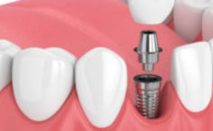 blog - Dorset Dental